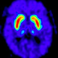 De zin en onzin van scans bij Parkinson